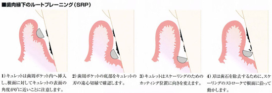 歯周病治療の基本~ルートプレーニング(SRP)~